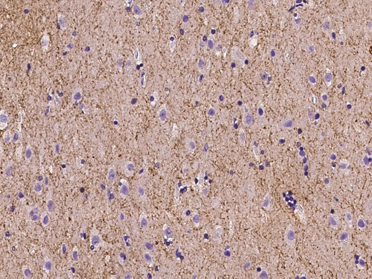 Tenascin-C as predictor of left ventricular remodeling and mortality in patients with dilated cardiomyopathy